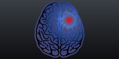 NHG-Standaard Beroerte