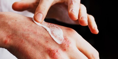 Hand met eczeem waarop witte crème wordt gesmeerd