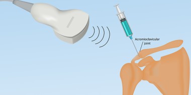 Echogeleide injectie