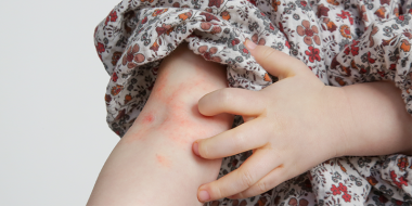 Constitutioneel eczeem