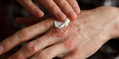 Krachtig corticosteroïd