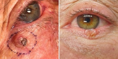 Twee voorbeelden van kwaadaardige ooglidtumoren