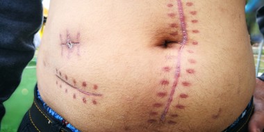 Oncologische follow-upzorg