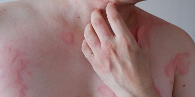 Chronische spontane urticaria