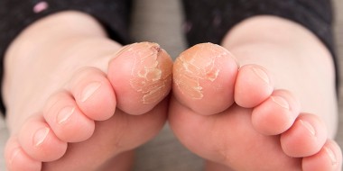 Juveniele plantaire dermatose