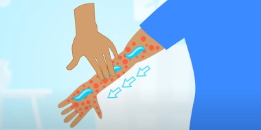 Illustratie van arm met uitslag waarop zalf wordt gesmeerd