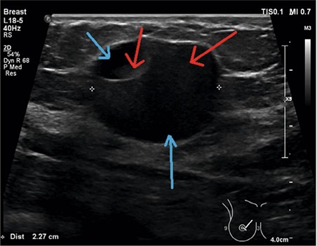 Echobeeld van een galactocele. De rode pijlen wijzen een hogere dichtheid/reflectie aan, dus vet/melk. De blauwe pijlen wijzen waterscheiding/-verdeling aan.