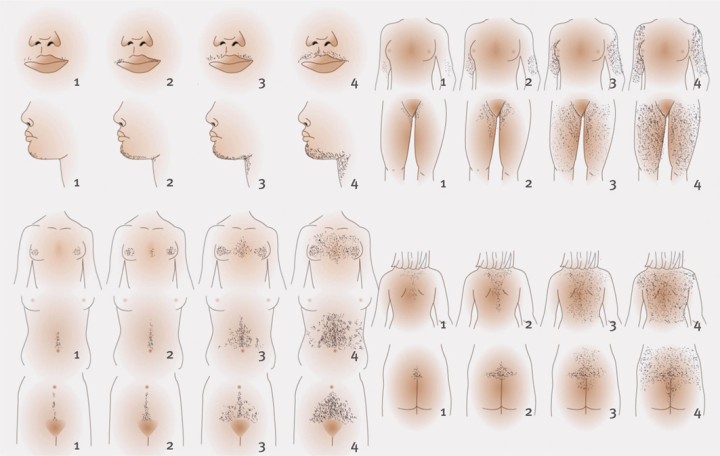Hirsutisme: de gemodificeerde ferriman-gallweyscore