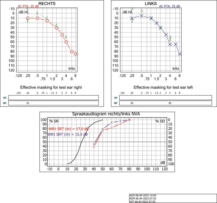 Het audiogram van meneer Aalbers.