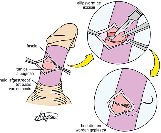 Operatieve mogelijkheden bij de ziekte van Peyronie: Nesbit- of een andere verkortende techniek