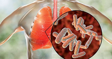 In bepaalde situaties kunnen corticosteroïden als adjuvans bij pneumonie overwogen worden, bijvoorbeeld wanneer een ziekenhuisopname ongewenst is.