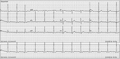Het ecg met voltageafwijkingen passend bij LVH