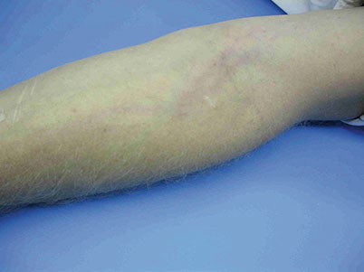 Ontstoken lymfevaten ten gevolge van de ontsteking van de duim