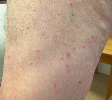 Bovenbeen van de patiënt met diverse bedwantsbeten: lineair en in clusters gerangschikte erythemateuze papels