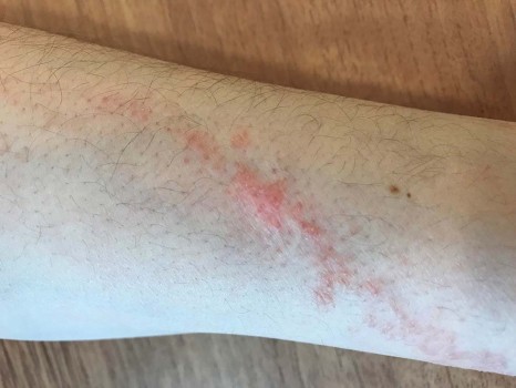 Een lineaire erythematopapulosquameuze laesie