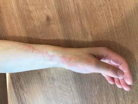 De laesie loopt op de linkerarm vanaf de hand naar de onderarm over een blaschkolijn