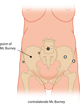 contralaterale Mc Burney