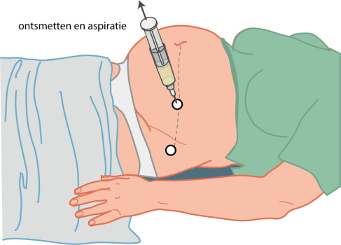 ontsmetten en aspiratie