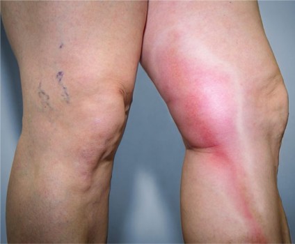 Bij elke behandeling met anticoagulantia past een afweging tussen het risico op trombose en het risico op een bloeding.