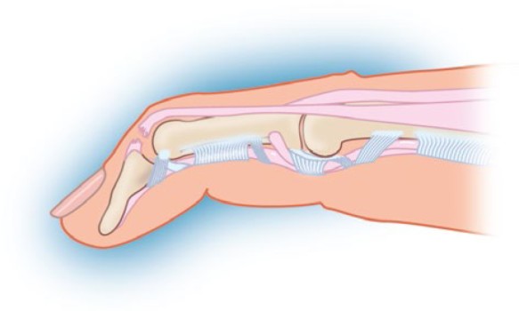 Figuur 1 soft tissue mallet fnger