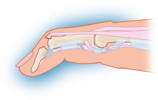 Figuur 2 Bony tissue mallet finger