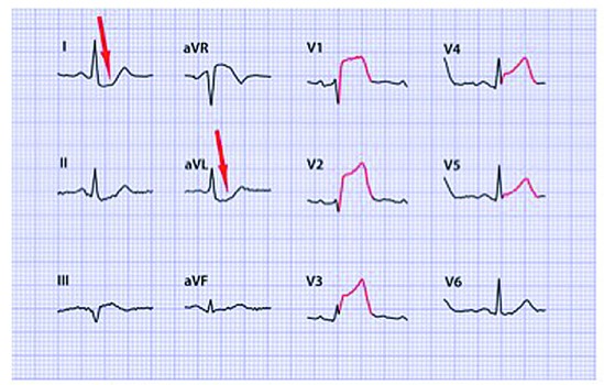 Weergave van de universele definitie van een myocardinfarct