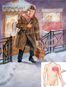 Het klassieke, maar ook achterhaalde beeld van pijn op de borst: ‘typische klachten’ bij een mannelijke patiënt.