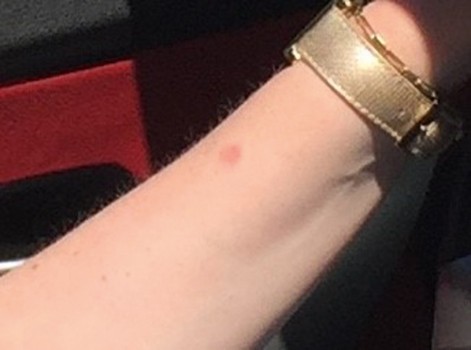 Een door de patiënte zelf genomen vakantiefoto (detail van de linker onderarm)