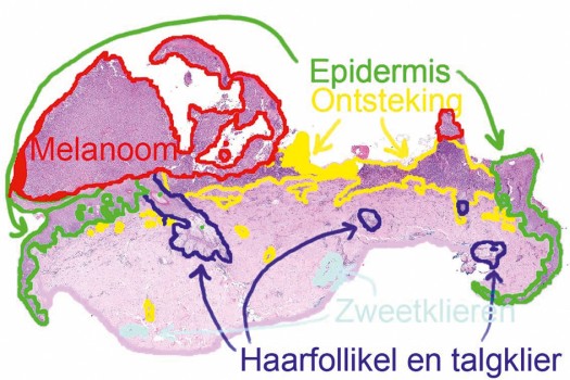 Hetzelfde excisiepreparaat, met uitleg van de histologie
