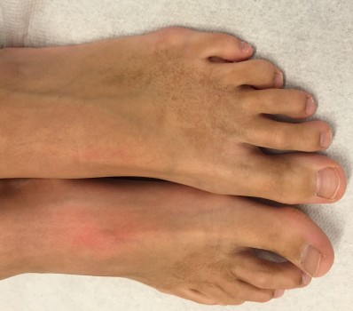 Bij feoderma helpt wassen met water en zeep niet, vaak lukt het wel de vlekken met alcohol te verwijderen.