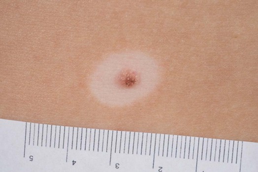 Naevus met symmetrische zone van depigmentatie