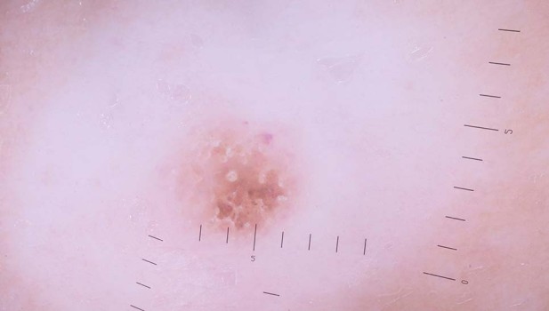 Dermatoscopisch beeld van de halonaevus