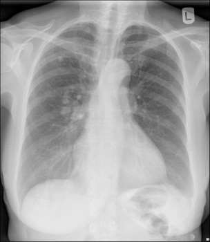 X-thorax: diverse intrapulmonale verdichtingen mediaal in de rechter long
