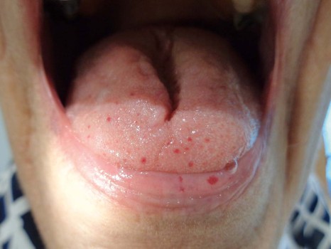 Teleangiëctasieën op lippen en tong