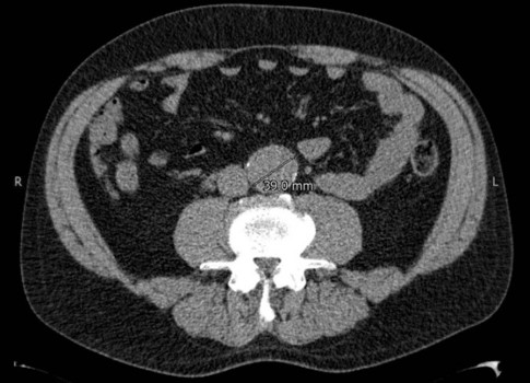 Aneurysma van de buikaorta in 2013: diameter 3,9 cm
