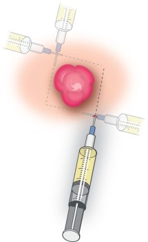 Lokaal anesthesie met veldblok