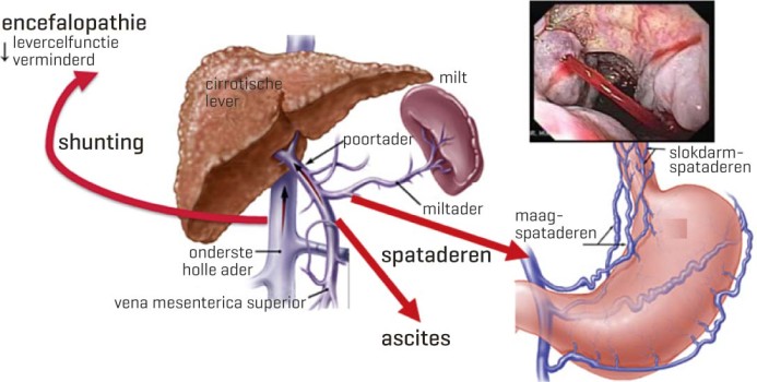 Lever met cirrose en klinische verschijnselen