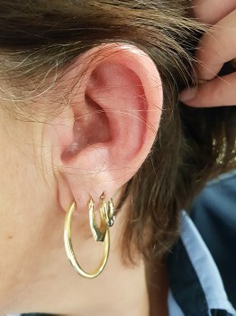 Een pijnlijk, rood oor is niet altijd een cellulitis/erysipelas.