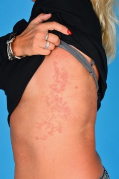 Casus 1, dag 10: gegroepeerde rode vesikels op de linkerflank