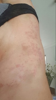 Casus 1, dag 25: rode en deels (postinflammatoir) gehyperpigmenteerde maculae