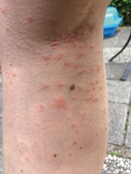 Casus 2, dag 45: terugkerende huidreactie, met rode papels buiten het contactgebied, hier in de knieholte