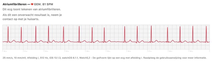 Ecg-registratie met smartwatch en smartphone, opgenomen door een 75-jarige patiënt