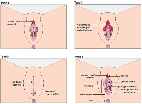 Typen vrouwelijke genitale verminking volgens de WHO-classificatie