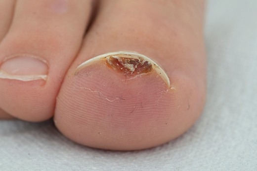 De grote teen van patiënt A met exostose zichtbaar distaal op de eindfalanx digitus 1.