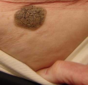 Verruca seborrhoica
