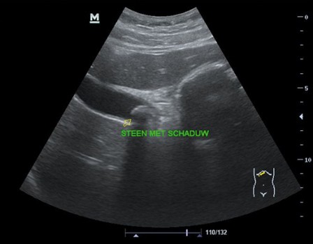 Galsteen met slagschaduw