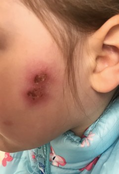 Een meisje met laesies in het gelaat