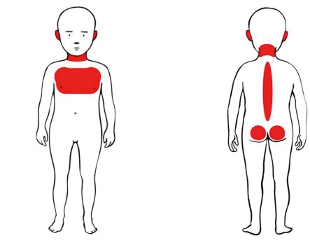 Locaties met sterk verhoogde kans op toegebrachte blauwe plekken