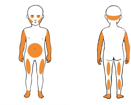 Locaties met verhoogde kans op toegebrachte blauwe plekken