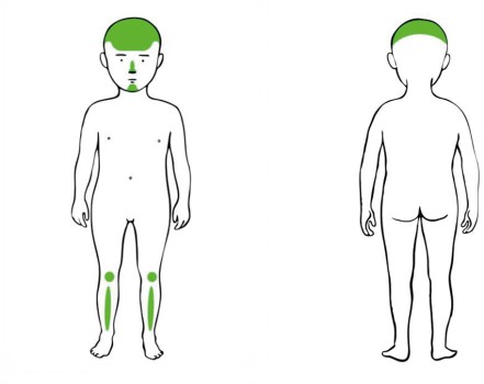 Meest voorkomende locaties van accidentele blauwe plekken